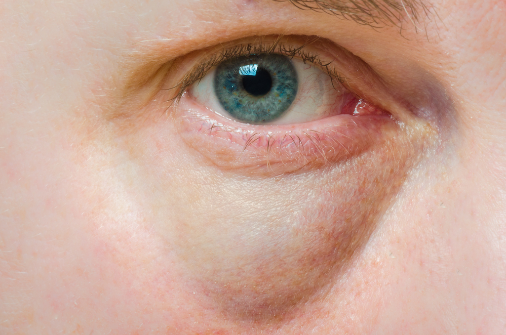 Co na oteklé očí alergie?