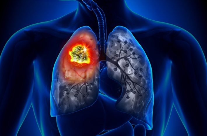 Nehty a rakovina plic spolu mohou souviset