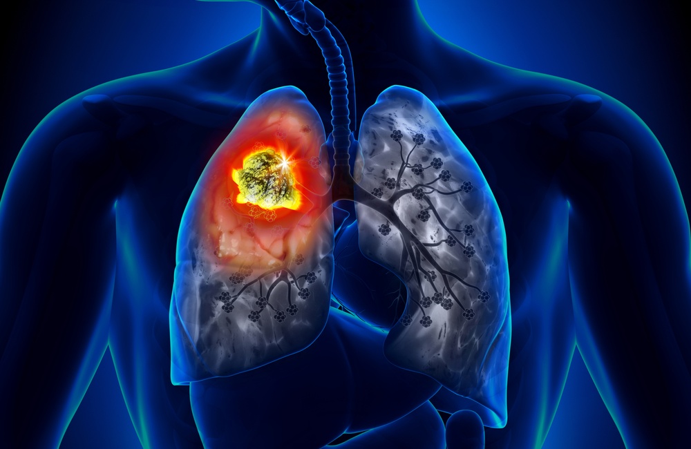 Nehty a rakovina plic spolu mohou souviset. Obrázek plic.