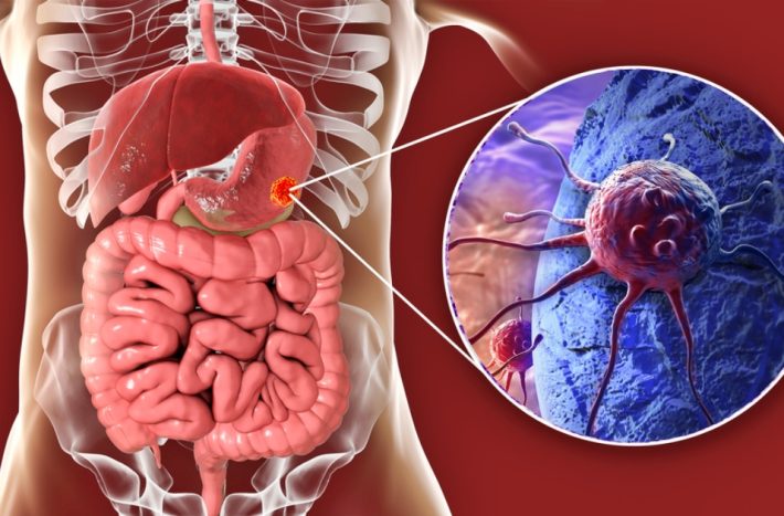 Vyv j Se Bez P znak Mnoho Let Rakovina aludku