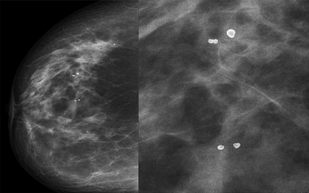 Rakovina prsu 