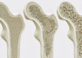 osteoporóza