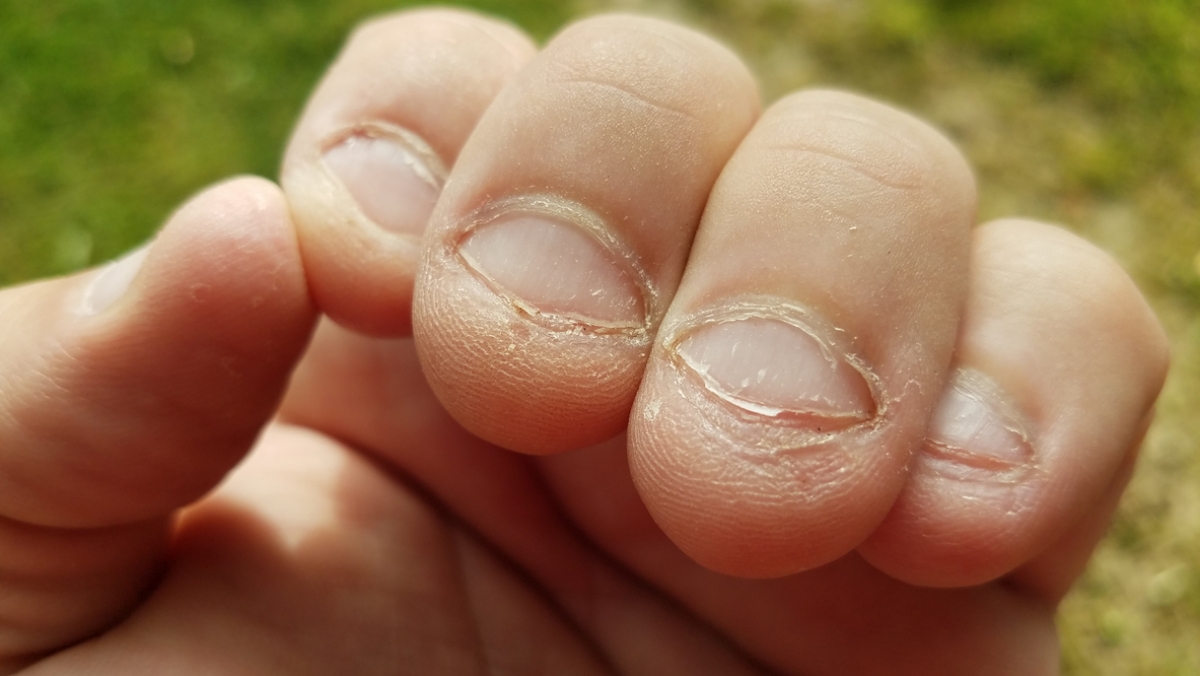 Co může způsobit kousání nehtů?