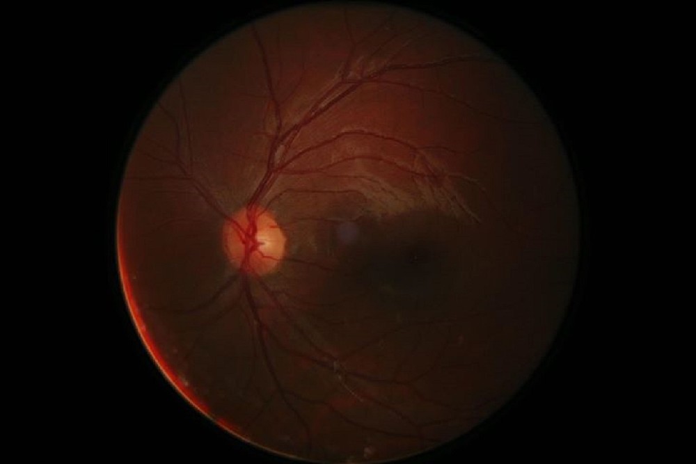Digitální fotografie sítnice oka