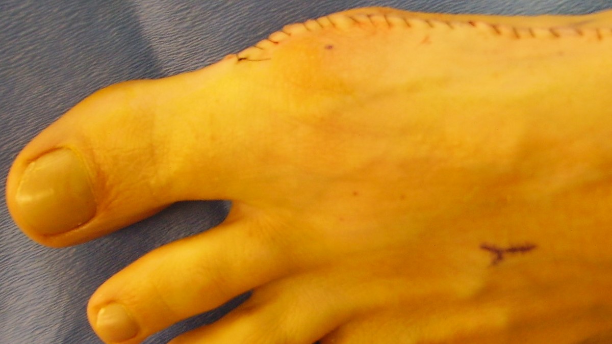 Jak se vyhnout vbočeným palcům a jak je léčit doma