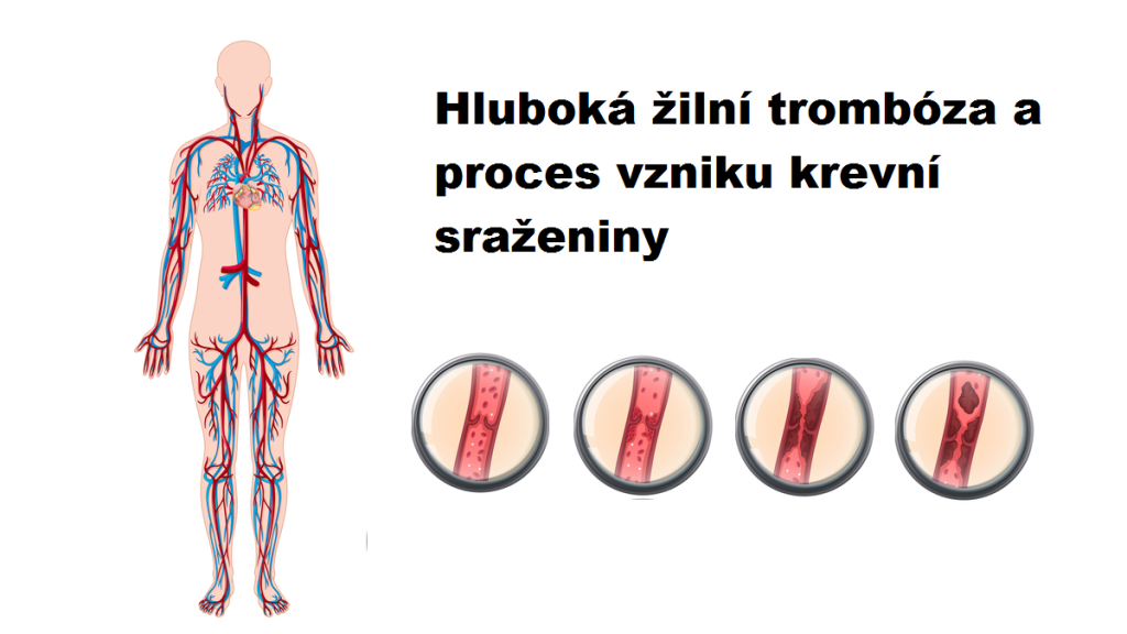 Obrázek z anatomie člověka zobrazující cévní systém a čtyři malé obrázky znázorňující fáze tvorby krevní sraženiny