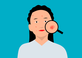 Kreslený obrázek ženy s akné a lupou zvětšující jeden z pupínků na její tváři