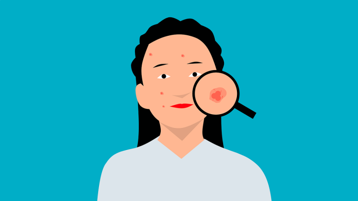 Kreslený obrázek ženy s akné a lupou zvětšující jeden z pupínků na její tváři
