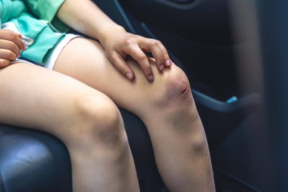 Děvčátko s poraněným kolenem a modřinami na nohou