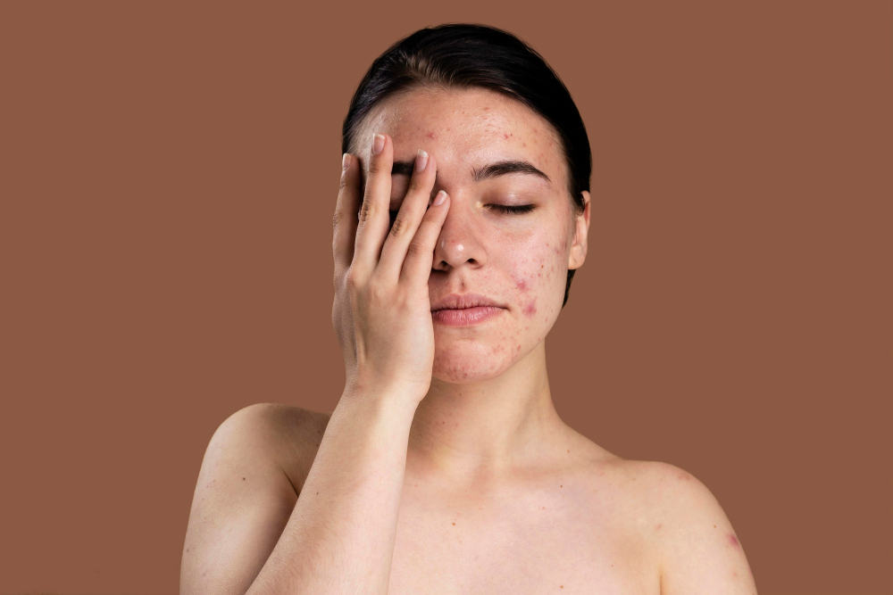 Mladá dívka s akné zakrývající si polovinu obličeje rukou