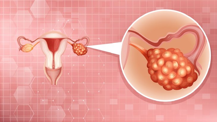 Ilustrace dámského reprodukčního ústrojí s detailem na změněný vaječník rakovinným bujením