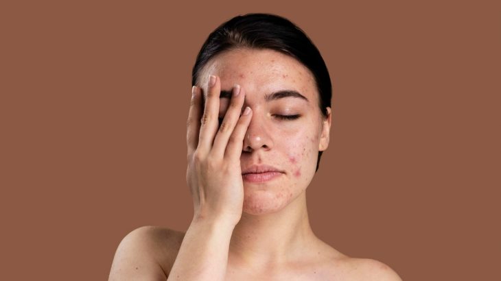 Žena zakrývající si půlku obličeje s akné