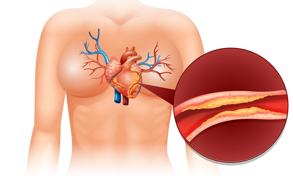 Ilustrace zablokované tepny v srdci cholesterolem