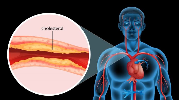 Ucpaná tepna cholesterolem